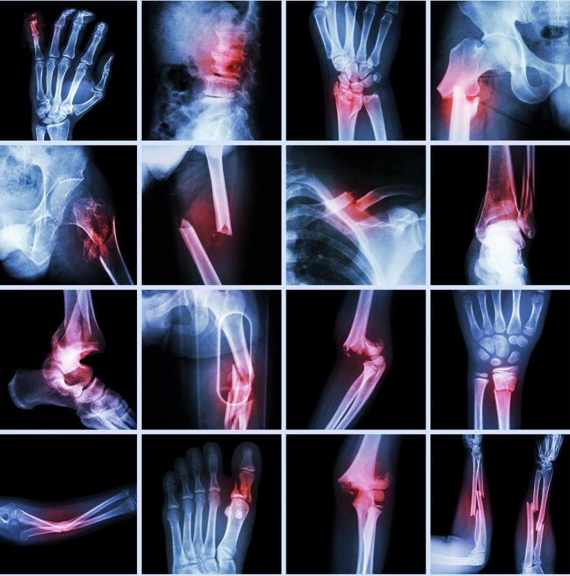 Bone Injury:  6 Nutrition tips for that speedy recovery.